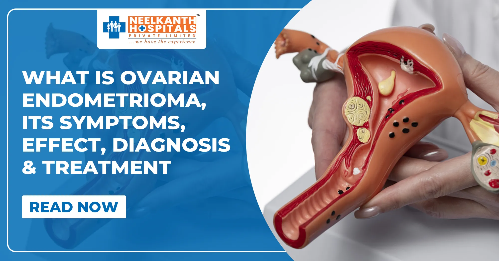 What is Ovarian Endometrioma? Its Symptoms, Effect, Diagnosis & Treatment